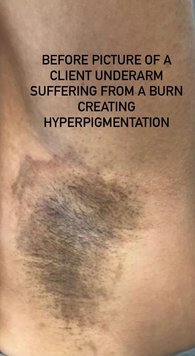 Herbal Inflammation & Hyperpigmentation Salve